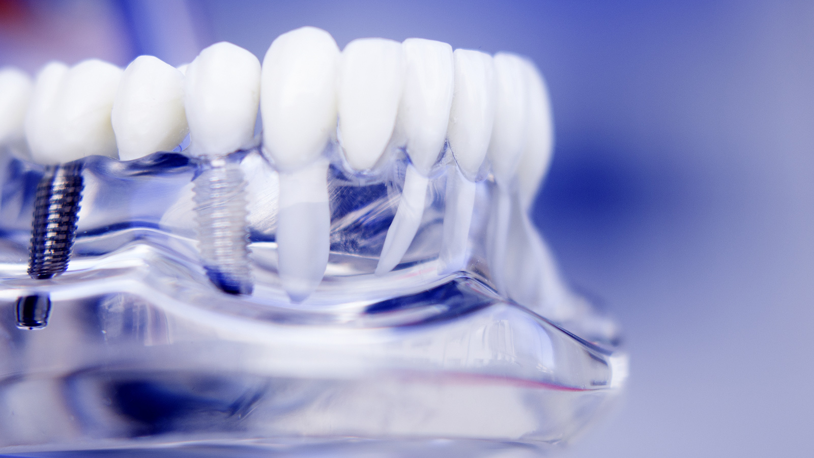 dental implant dentist, dental implant surgery